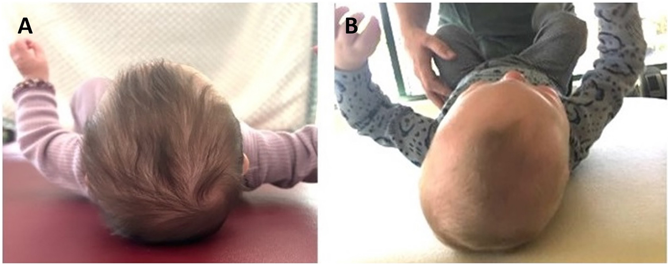 Figure 1: 
Superior views of pediatric heads. (A) A 4-month-old with a normocephalic head. (B) An 11-month-old patient with asymmetrical deformational plagiocephaly (DP) and occipital flattening.
