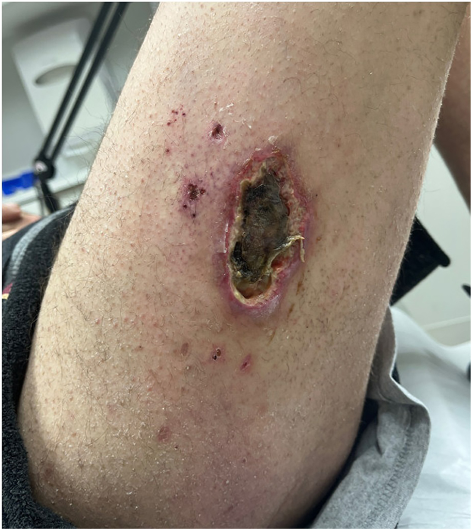 Figure 1: 
Right lateral thigh wound prior to sodium thiosulfate (STS) therapy.
