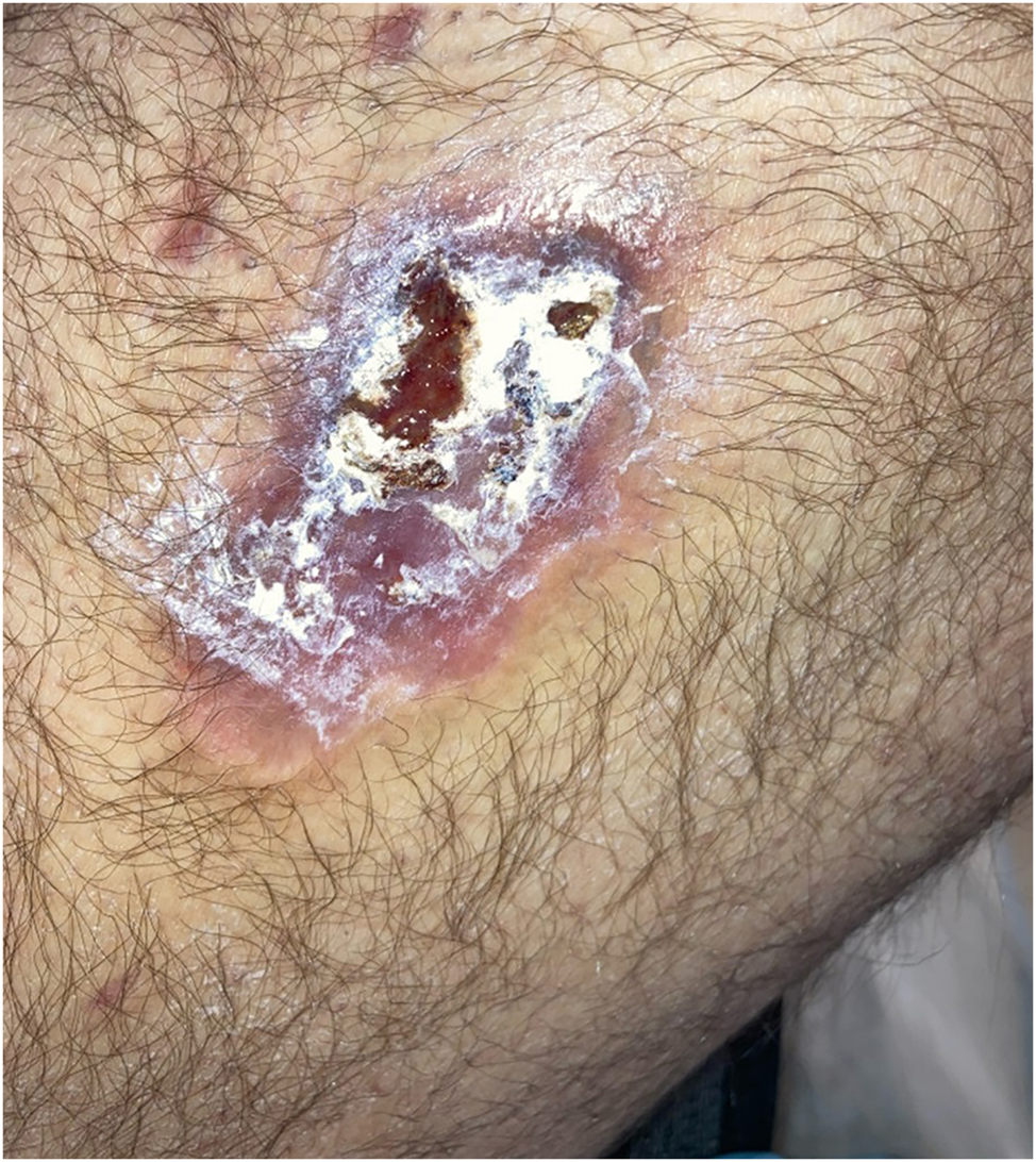 Figure 2: 
Right lateral thigh wound with silver alginate hydrophilic dressing present after 2 months of sodium thiosulfate (STS) therapy.
