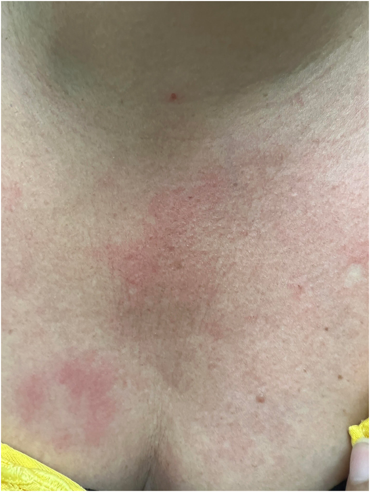Figure 3: 
Erythematous and edematous plaques on the central upper chest.

