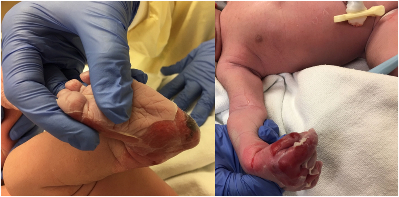 Figure 1: 
Images depicting the infant’s status postdelivery, exhibiting peeling of the skin on his hands and feet.
