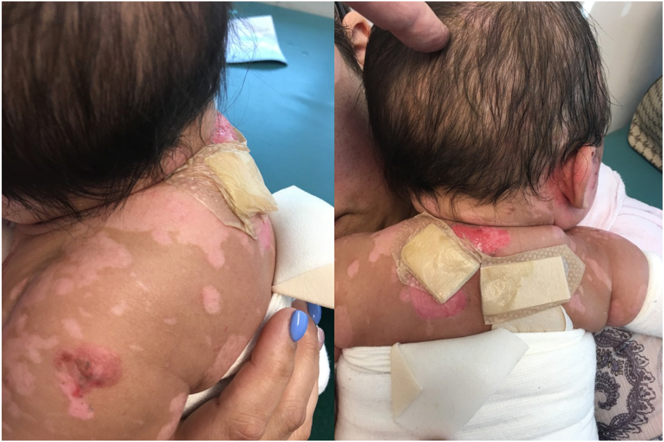 Figure 2: 
Images showing the state of the child’s skin lesions at eight months of age.
