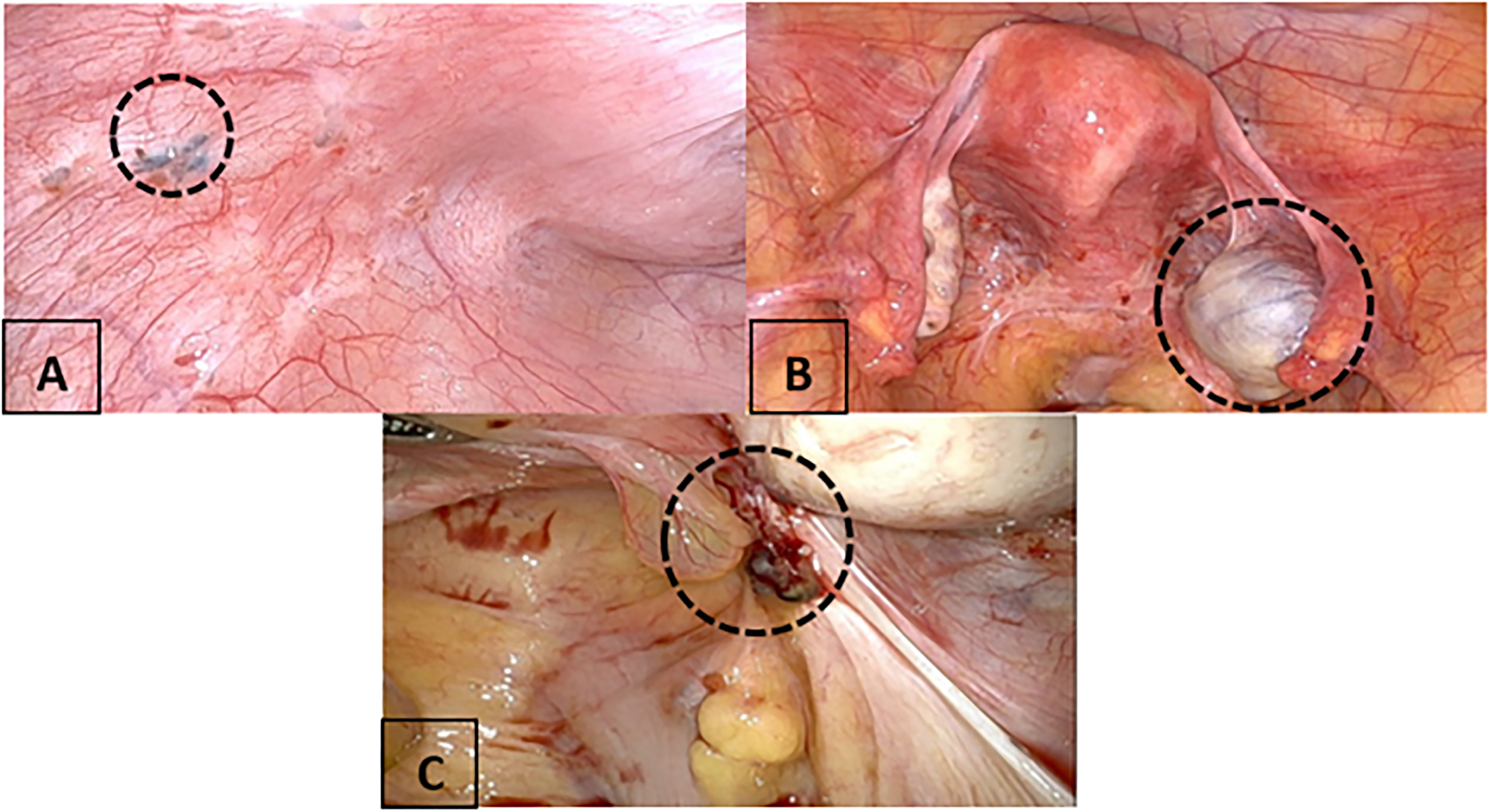 Figure 1:
The types of endometriosis lesions intraoperatively. (A) Superficial endometriosis with a powder burn. (B) Ovarian endometrioma. (C) Deep infiltrating endometriosis (DIE) lesion.
