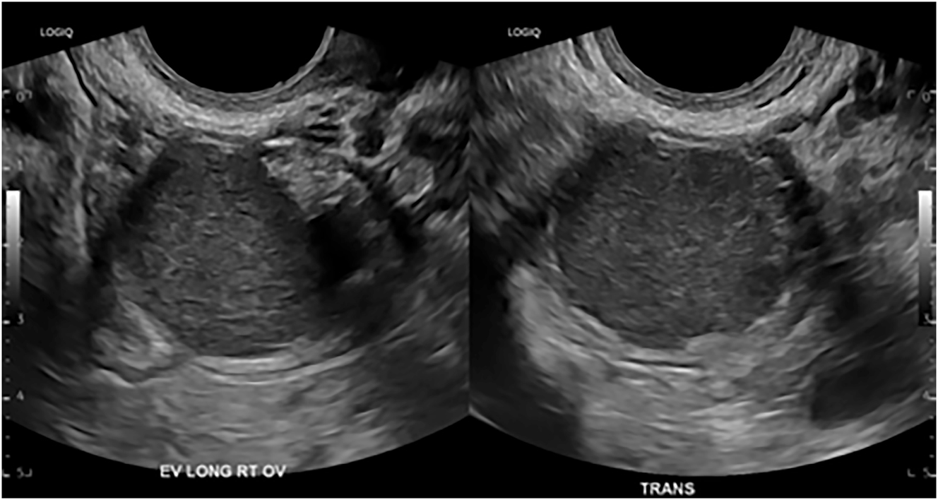Figure 2:
A transvaginal ultrasound image of an ovarian endometrioma measuring 3.2 cm.