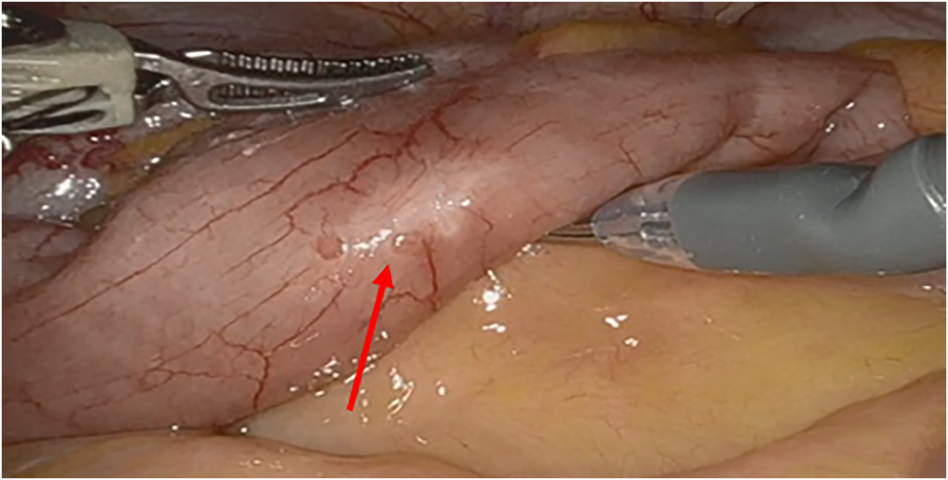 Figure 3:
An intraoperative image of the small intestines, with the red arrow pointing to a superficial endometriosis lesion.