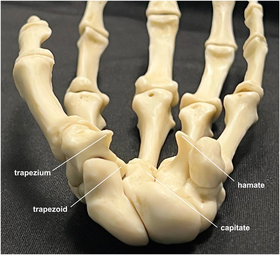 Figure 1:
The bony components of the carpal tunnel, radial to ulnar: trapezium, trapezoid, capitate, and hamate. The transverse carpal ligament runs between the tubercle of the trapezium and the hook of the hamate.