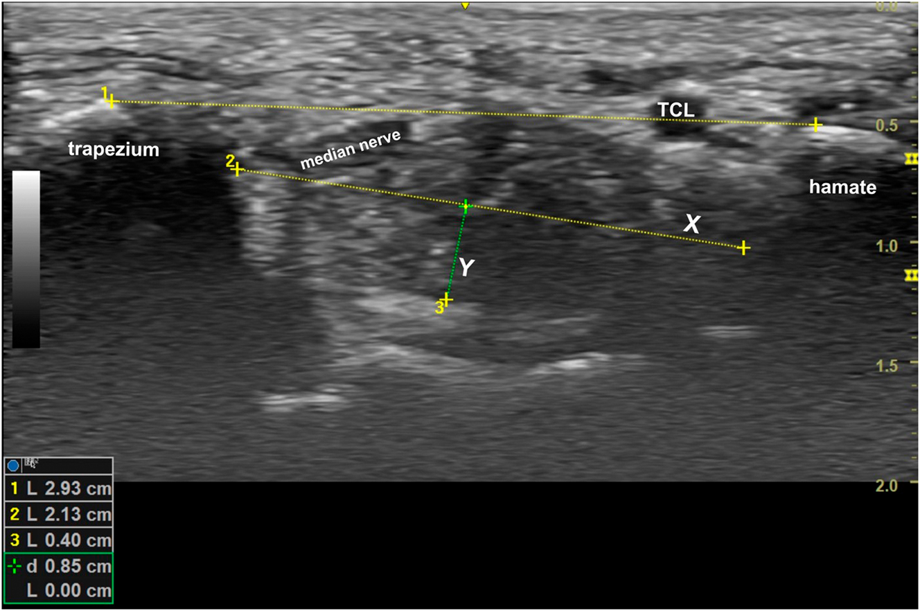 Figure 3:
The length of the transverse carpal ligament was measured on a short-axis ultrasound of the carpal tunnel at its most restrictive site beneath the transverse carpal ligament running between the hook of the hamate and the tubercle of the trapezium. The greatest width of the carpal tunnel was also measured (X), and a right-angle distance from this line down to the floor of the tunnel (Y) was calculated. The area was estimated by multiplying 1/2(X) (Y) (π).