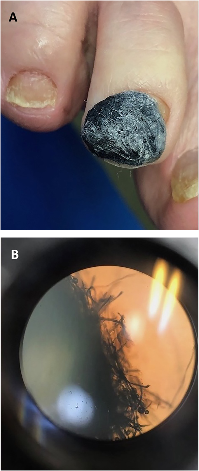 Figure 1: 
Pre- and post-removal of toenail black mass. (A) Black mass on a nail of an 81-year-old man undergoing treatment with ciclopirox lacquer for onychomycosis. (B) Microscopic examination of the black mass after removal.
