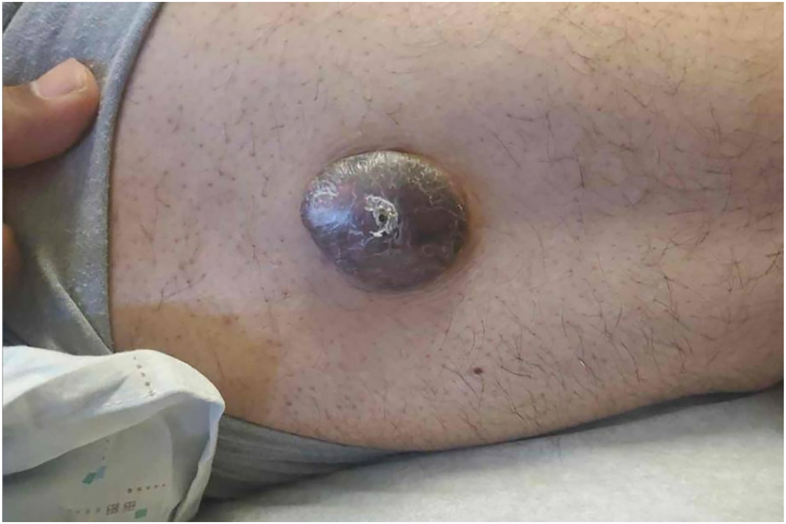 Figure 1:
A brown tumor, 3.2 × 2.5 cm in size, on the right lateral thigh.