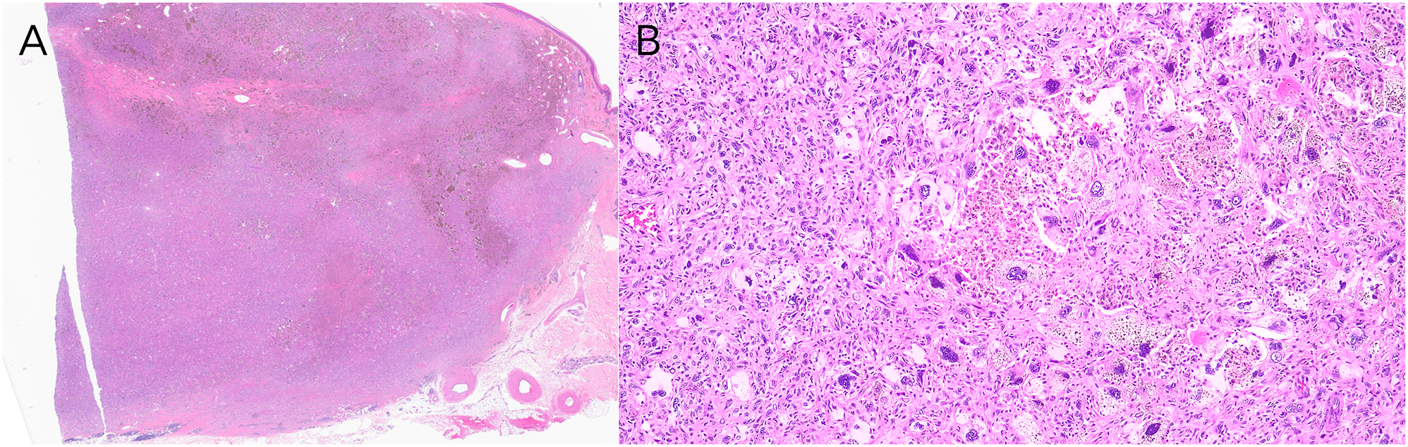 Figure 2:
Histopathology of the brown tumor. (A) Hematoxylin & eosin, original magnification ×1.25. Narrow excision of large, circumscribed, deeply extending intradermal and superficial subcutaneous proliferation of atypical spindled cells. (B) Hematoxylin & eosin, original magnification ×10. Excision with atypical spindled cells exhibiting marked pleomorphism, increased mitotic activity, and bizarre nuclei.