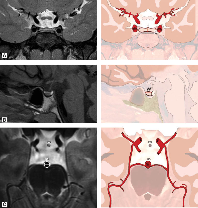 Figure 2 (A) Height and coronal width of the pituitary gland on coronal plane. (B) Width of the pituitary gland on sagittal plane. (C) Pituitary stalk and basilar artery on axial plane.