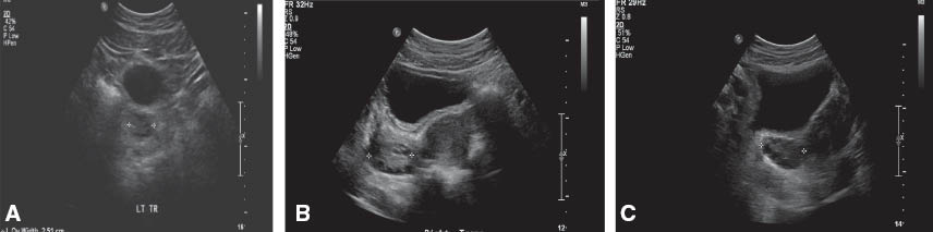 Figure 1 Transabdominal transverse ultrasound images (A) normal ovary. (B) Right ovary in a non-obese adolescent with PCOS (ovarian volume 13 mL). Several small follicles are peripherally located, without evidence of a dominant follicle. (C) Right ovary in an obese PCOS adolescent (ovarian volume 17 mL). Several small follicles are also peripherally located. Body habitus limits the quality of the image.
