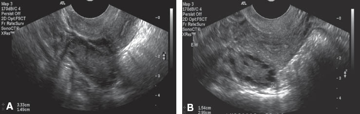 Figure 2 (A) Transabdominal longitudinal ultrasound image of the right ovary in an overweight adolescent with PCOS. (B) Transvaginal longitudinal ultrasound image of the right ovary in the same patient. The quality of the image is improved with transvaginal ultrasound.