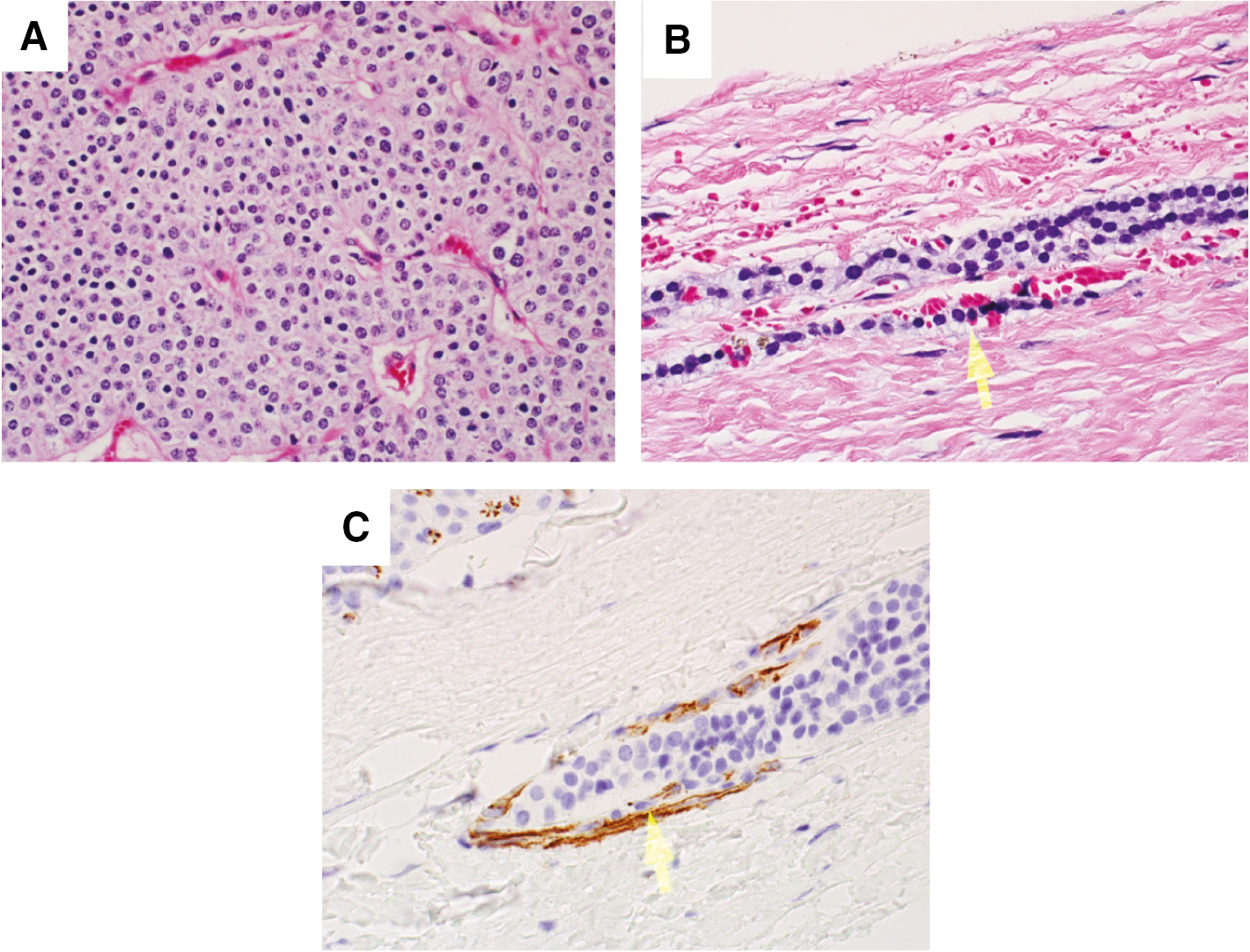 Figure 1: H&E and immunohistochemistry stains.(A) Photomicrograph of parathyroid carcinoma showing scattered atypical cells and focal intervening fibrous bands (H&E). (B) Photomicrograph showing vascular invasion (H&E). Arrow points to vascular invasion. (C) CDC31 immunohistochemistry showing vascular invasion. Arrow points to vascular invasion.