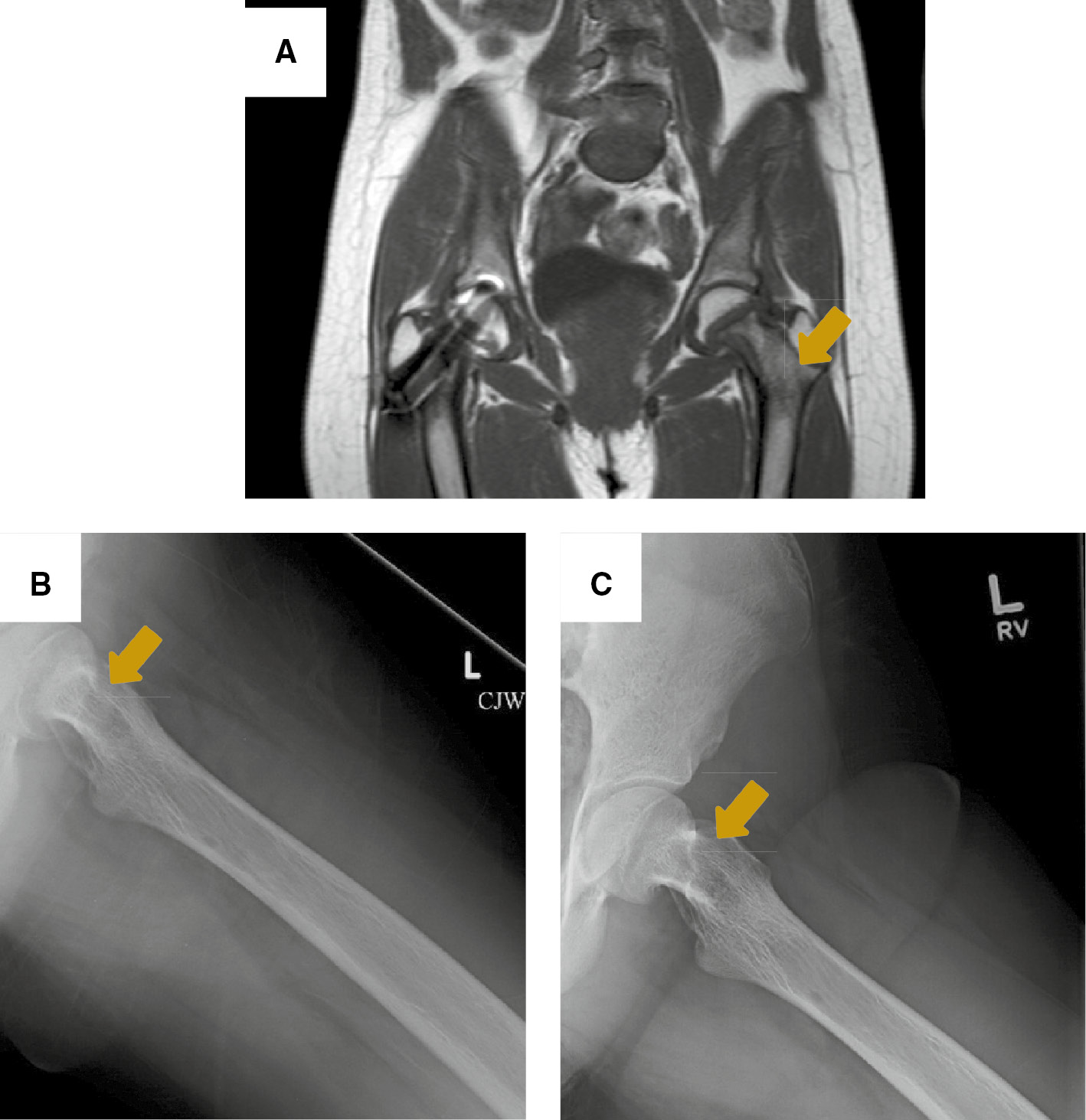 Figure 2: Brown tumor to the left femoral neck.(A) MRI of the hip on coronal plane showing a multilobulated cystic lesion occupying more than 50% of the left femoral neck. Arrow points to a brown tumor. X-ray views showing thickening of the trabeculae and a well-defined lucency to the medial aspect of femoral neck on post-operative week 1 (B), and 6 months later (C). Arrows point to a brown tumor.