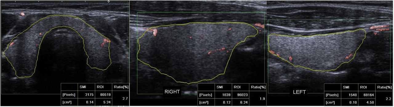 Figure 2: Quantitative SMI VI values were measured by manually drawing the contours of the thyroid gland structure on the cSMI mode, in the longest transverse plane, right lobe, and left lobe longitudinal plane. The quantitative VI values measured 2.7% in transverse plane, 1.9% in right lobe longitudinal plane and 2.2% in left lobe longitudinal plane.
