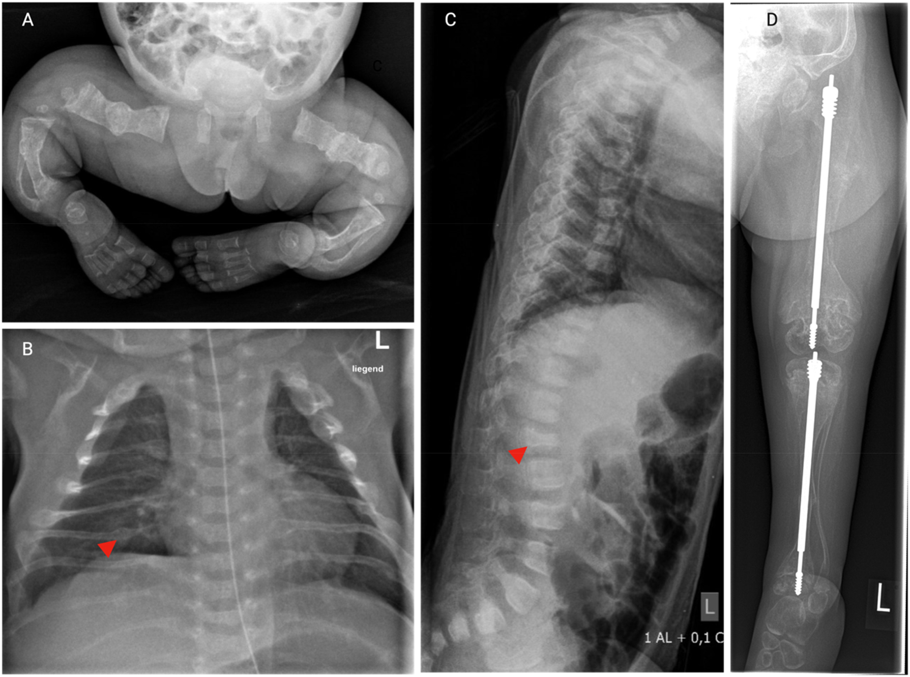 Figure 1:
Skeletal manifestations of OI. Series of X-rays from a young girl with severe OI type VIII. (A) X-ray of the lower body 3 days after birth showing multiple healed fractures, generalized osteopenia, bowing and shortening of the long bones. (B) Chest X-ray 3 days after birth. Notice the thin rips with irregularly shaped, thickened areas (arrow head) consistent with healed fractures. (C) Lateral X-ray of the spine in the age of 1.5 years reveals flattened, irregularly shaped vertebral bodies (arrow head), indicative of compression fractures, along with pronounced kyphosis. (D) X-ray of the lower extremity in the age of 5 years after surgical insertion of telescopic nails in the tibia and femur. Notice the generalized osteopenia, thin cortical bones, multiple fractures in the tibia and femur, and bowing of the thin fibula. The distal metaphyses of the femur appear wide and irregular.