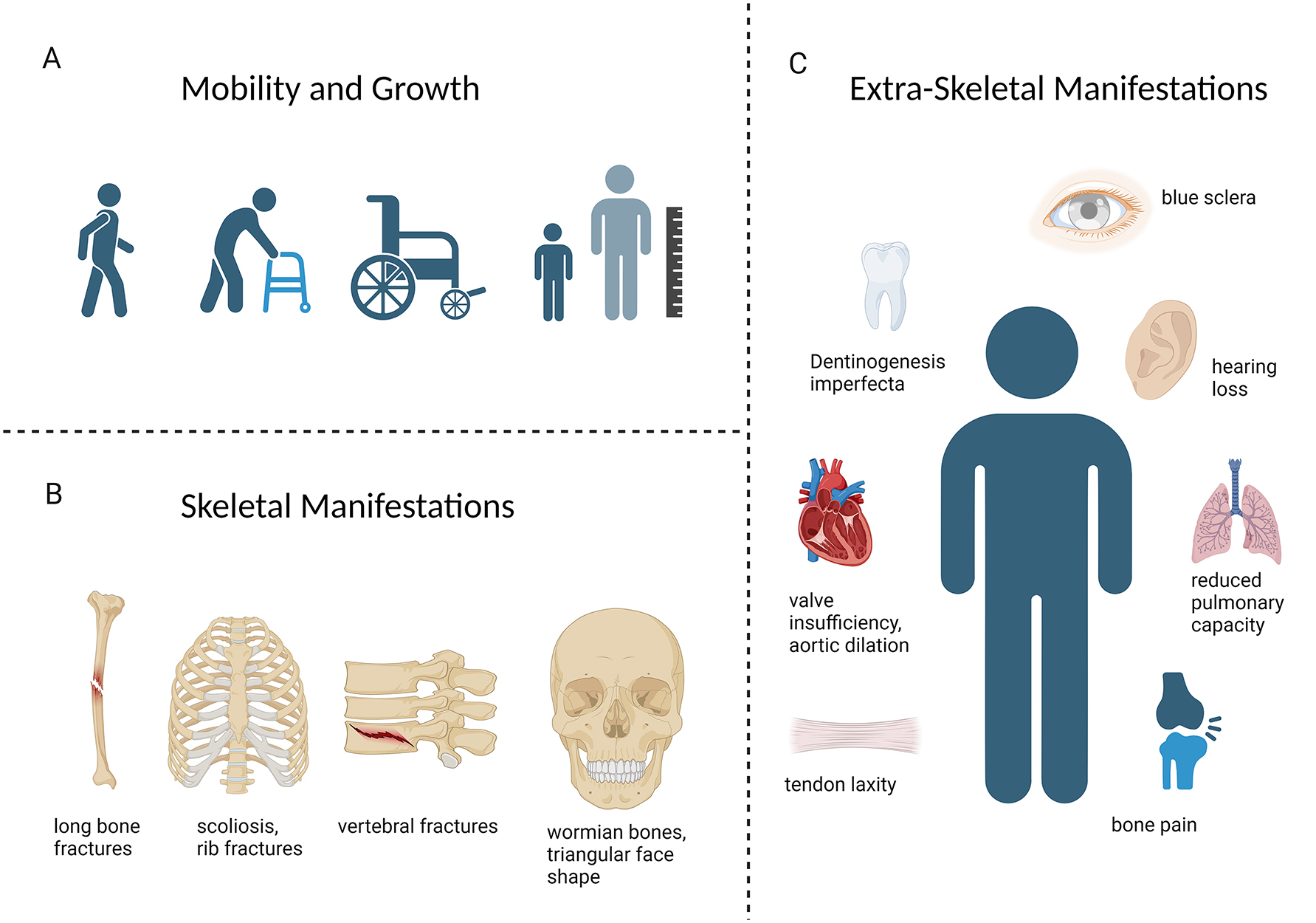 Figure 2:
Clinical manifestations of OI. (A) The phenotype of OI ranges from patients with mild forms who maintain full mobility, to those who rely on walking aids or are wheelchair dependent. Short stature is commonly present. (B) Skeletal manifestations of OI include fractures and deformities of the long bones, scoliosis, vertebral fractures, and craniofacial features like wormian bones, and a characteristic triangular face shape. (C) Extraskeletal manifestations occur due to the widespread presence of collagen I in various organ systems. Structural abnormalities in heart valves, blood vessels, and the lung parenchyma can restrict cardiopulmonary function and cause potentially lethal complications. Blue sclera and dentinogenesis imperfecta are characteristic facial features. Early-onset hearing loss and ligamentous laxity can also occur.