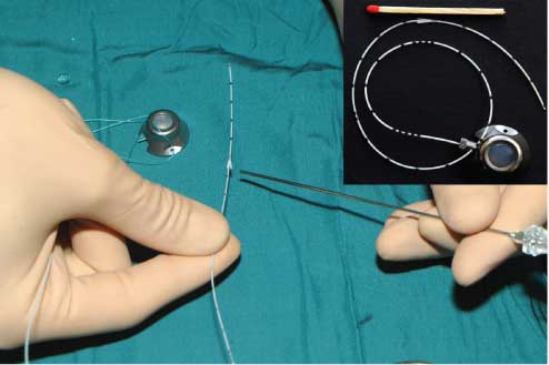 Figure 1 AFT port system.The needle points at the anchor fixation system that we developed to avoid the dislocation of the catheter. The port capsule is prepared for transplantation.