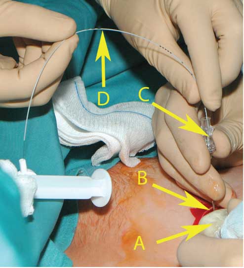 Figure 2 The insertion of the catheter into the amniotic cavity under ultrasound guiding.(A) Ultrasound probe. (B) The pouch prepared for the port capsule. (C) The amniotic cavity was punctured with an 18-gauge needle through the prepared pouch. (D) The port catheter has been inserted into the amniotic cavity through the 18-gauge needle.