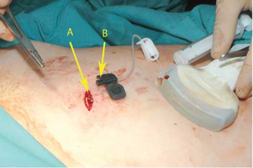 Figure 3 The final control of the system after port implantation.(A) The prepared pouch with the implanted port system before closing the skin. (B) The amniotic fluid substitute solution is injected into the port system through the atraumatic 25-gauge needle.