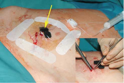 Figure 4 The closure of the operation field.After the skin has been closed, the port capsule is punctured with a 25-gauge needle (indicated by the arrow). The operation field was covered with the sterile transparent foil for the sufficient control of the wound situation as well as to make a decision before changing the needle.