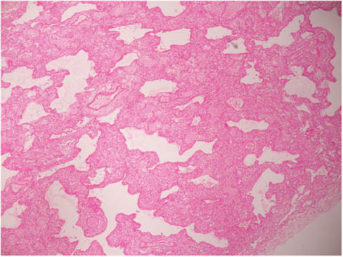 Image 1 Exudative fibrinous pneumonia with hyaline membrane-like changes (H&E 10×).
