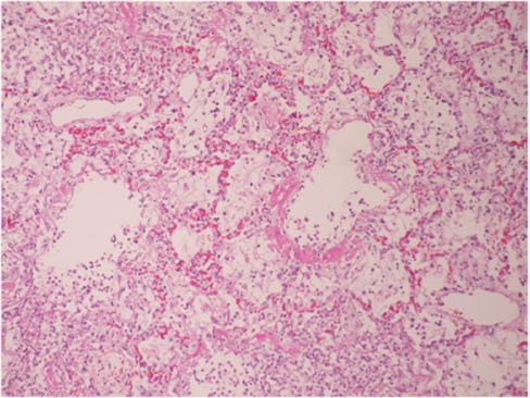 Image 2 Necrotizing alveolitis, prominent exudation of cell and damage of alveolar wall (H&E 40×).