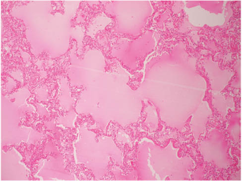 Image 3 Alveolar edema (H&E 10×).