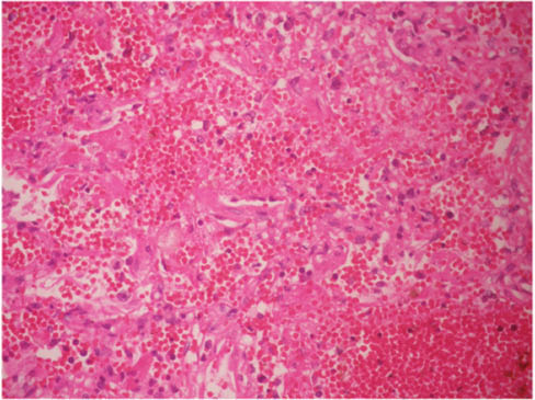 Image 4 Alveolar hemorrhage (H&E 40×).