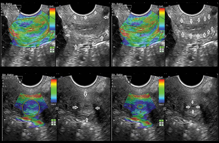 Figure 1 Cervical elastography and strain rate calculation in sagittal and cross sectional projections of the cervix. The boundaries of the endocervical canal and of the entire cervix are highlighted in the corresponding gray scale image.