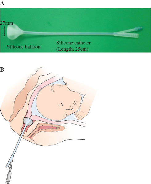 Figure 1 (A) The transcervical amniotic fluid collector (Yoon’s AF Collector™). (B) Schematic drawing of Yoon’s AF Collector™ placed in the vagina.