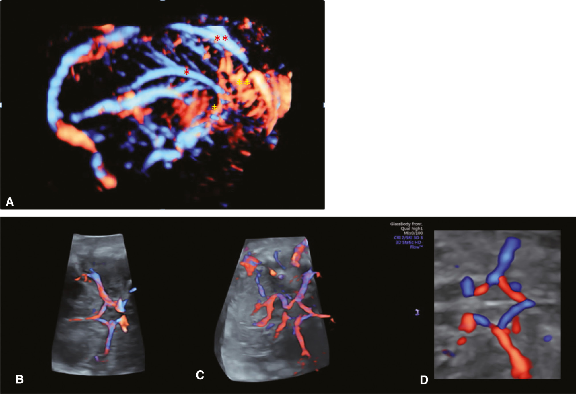 Figure 1: 3D angiography (bidirectional power Doppler ultrasound imaging).(A) Normal fetal intracranial circulation. Notice the pericallosal vascularization. PA (pericallosal artery), ACA (anterior cerebral artery), ACA branches, SSS (superior sagittal sinus). (B–D) The circle of Willis presented in advanced STIC (spatio-temporal image correlation), 3D HD flow, Glass body rendering mode.