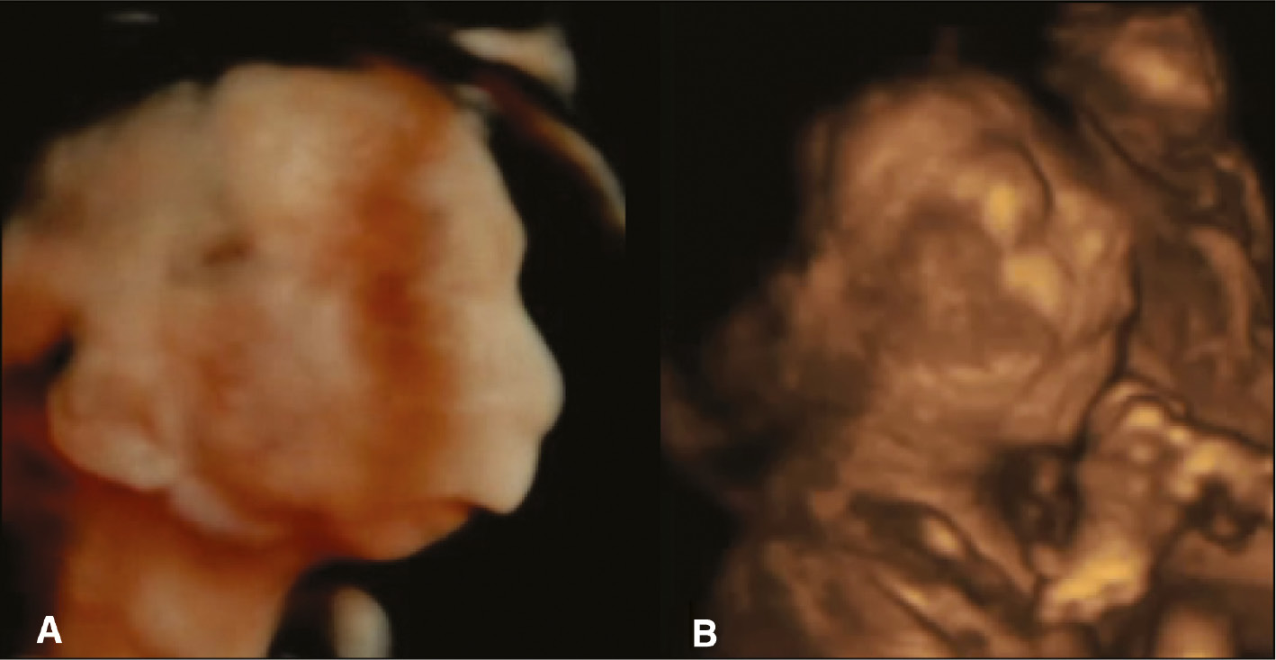 Figure 5: Prenatal detection of micrognathia with low-set ears by 3D HDlive surface rendering.(A) In a fetus with detected Pierre- Robin sequence (PRS). (B) In a fetus with Meckel-Gruber syndrome (courtesy of S. Panchal).