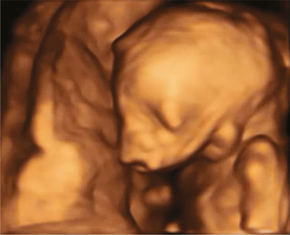 Figure 8: 3D surface rendering image of fetus at 19 gestational weeks with Treacher-Collins syndrome and typical facial dysmorphism: bilateral symmetrical otomandibular dysplasia with hypoplasia of soft tissues is observed in the malar bone, inferior orbital rim and cheek (image courtesy of S. Panchal).