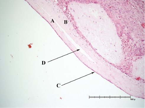 Figure 1: Chorio-amniotic membranes.(A) amniotic membrane, (B) chorionic membrane, (C) amnion epithelium, (D) very fine fibrous network developing after overlapping of the membranes during the 12th–15th weeks’ gestation.
