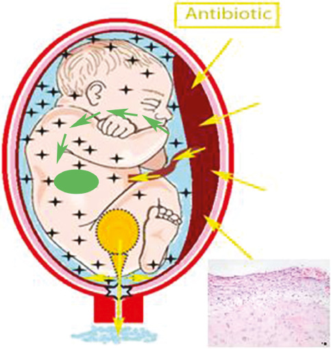 Figure 3: PPROM situation under antibiotic treatment. marks bacteria colonization. Fetal urine containing antibiotic from maternal circulation leaves amniotic cavity through membrane rupture without having a sufficient effect to eliminate bacteria. Histological examination with PPROM related chorioamnionitis. (With permition of S. Karger AG, Medical and Scientific Publishers, [67]).