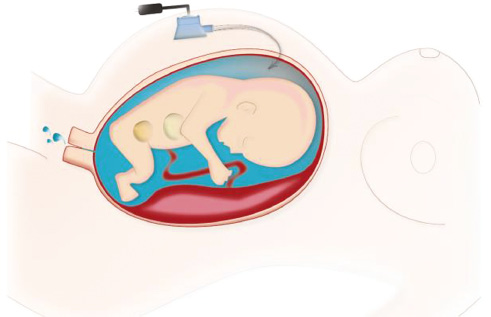 Figure 4: “Flush out” option: continuous amnio-infusion with hypotonic saline solution related to human amniotic fluid (100 mL/h, 2400 mL/day) via subcutaneously implanted perinatal port system.