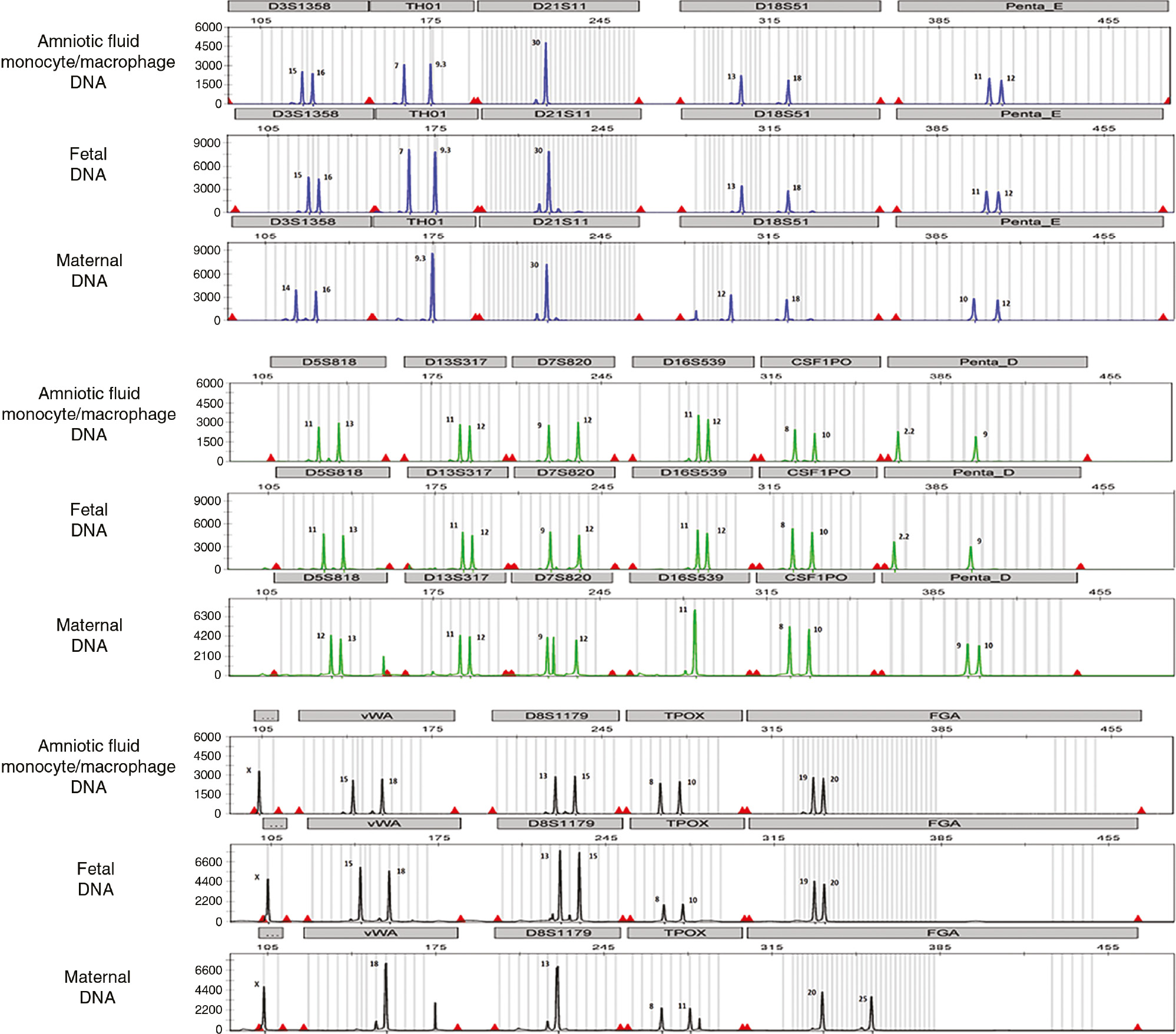Figure 2: DNA fingerprinting of amniotic fluid monocytes/macrophages that were mostly of fetal origin.DNA fingerprinting of purified amniotic fluid monocytes/macrophages, the fetus (umbilical cord) and the mother (buffy coat from peripheral blood) is shown in electropherograms. Each electropherogram contains 16 genetic sites: D3S1358, TH01, D21S11, D18S51, Penta_E, D5S818, D13S317, D7S820, D16S539, CSF1PO, Penta_D, X- and Y-specific amelogenin genes, vWA, D8S1179, TPOX and FGA. Each electropherogram was separated into three sections: blue, green and black. Each color indicates the dye used for the PCR multiplex: blue represents the genes amplified using fluorescein (FL dye), green represents the genes amplified using 6-carboxy-4′,5′-dichloro-2′,7′-dimethoxyfluorescein (JOE dye) and black represents the genes amplified using tetramethylrhodamine (TMR dye). Each genetic site has STR alleles, which is represented by peaks. The number next to each STR allele (peak) is the number of repeats for each STR allele. The DNA fingerprinting of the amniotic fluid monocytes/macrophages is identical to the DNA fingerprinting of the fetus.