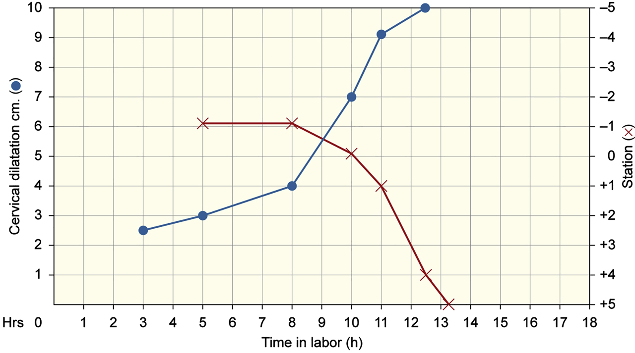 Figure 1: 
Characteristic patterns of normal cervical dilatation and fetal descent depicted graphically against elapsed time.
