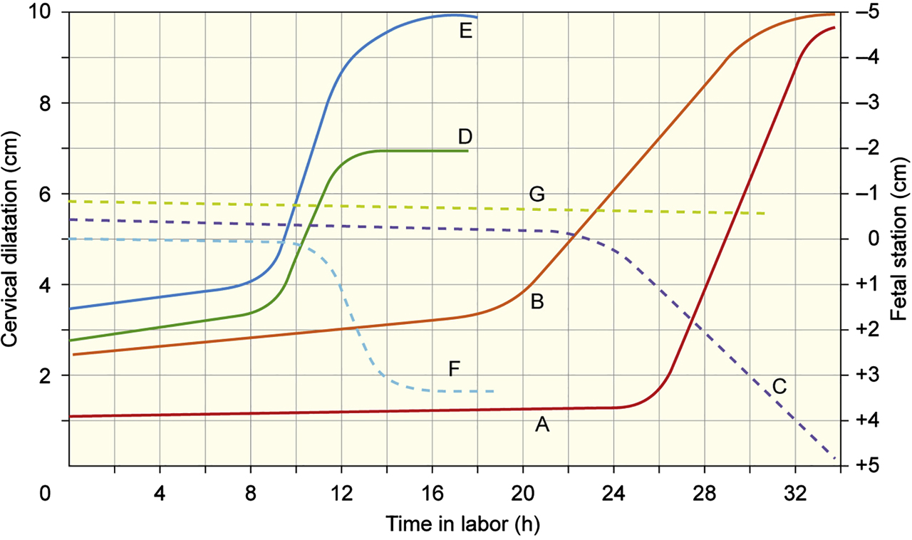 Figure 2: 
Labor disorders that can be identified on the basis of deviations from the expected normal duration, slopes and patterns of the dilatation and descent curves are illustrated graphically.
(A) Prolonged latent phase; (B) Protracted dilatation; (C) Protracted descent; (D) Arrest of dilatation; (E) Prolonged deceleration phase; (F) Arrest of descent; (G) Failure of descent. By permission from Cohen WR and Friedman EA in Kurjak A, Chervenak FA (eds) Textbook of Perinatal Medicine, 2nd edition. Informa UK, London, 2006:p1824.
