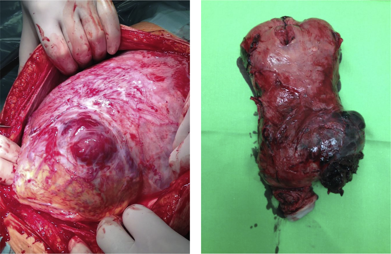Figure 1: Placenta accreta spectrum (PAS).(A) Abdominal cavity with pregnant uterus (B) Fetus delivered through fundal incision, and hysterectomy was performed while placenta was left in situ.