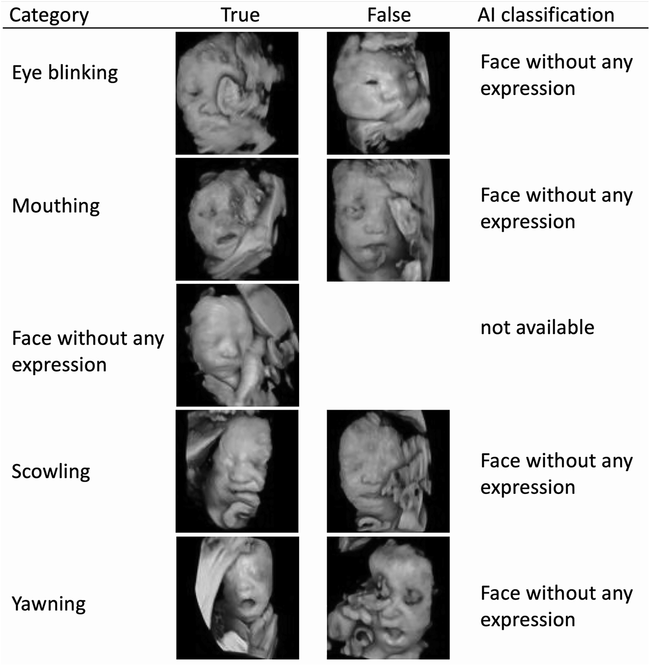 Figure 3: The sample images of true and false classifications by artificial intelligence (AI).The AI classification for false cases in each category is shown. All neutral fetal facial expressions were correctly classified, then the false case in the neutral category is missing.