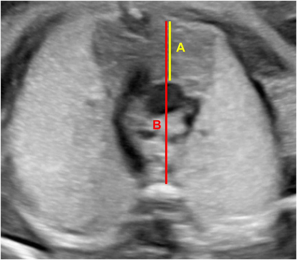 Figure 1: 
Thymus and thorax diameters. (A) Thymus diameter (anteroposterior thymus diameter) and (B) thorax diameter (intrathoracic mediastinal diameter), TTR: (A)/(B).
