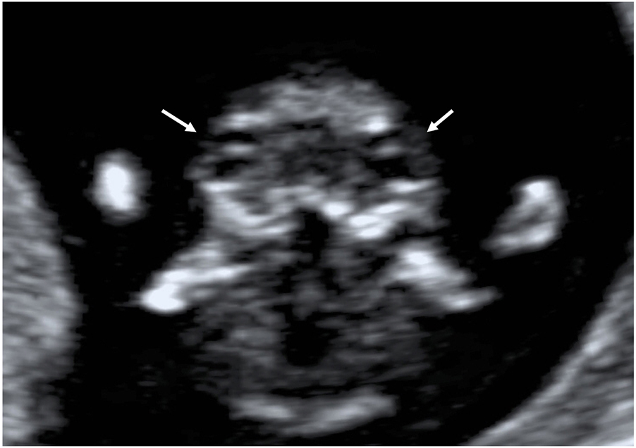 Figure 4: 
Fetal eyes and lenses on an axial plane (arrows).
