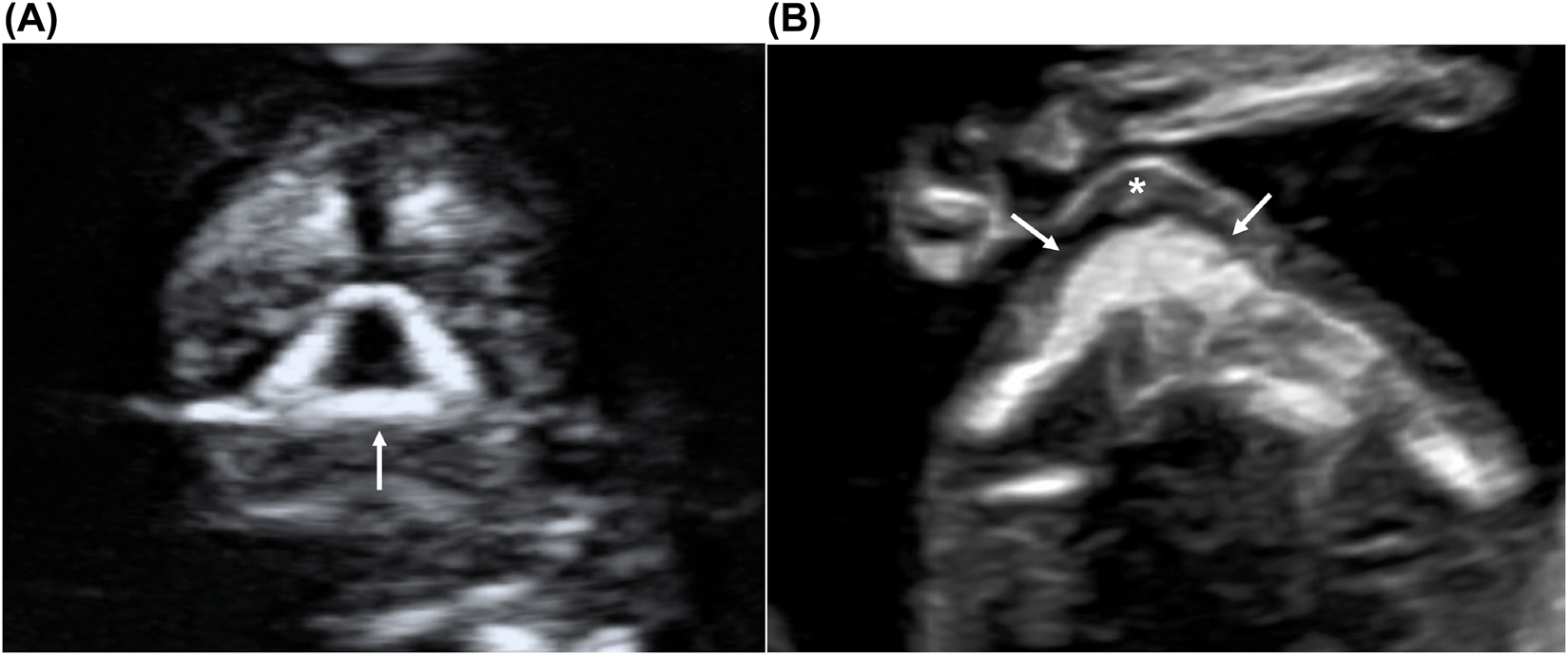 Figure 5: 
Fetal bony palate (arrows) on coronal (A) and axial (B) planes.
The bony palate represents the base of the retronasal triangle visible on the coronal plane (A, arrow), whereas the alveolar ridge (arrows) and upper lip (*) are visualized on the axial plane (B).
