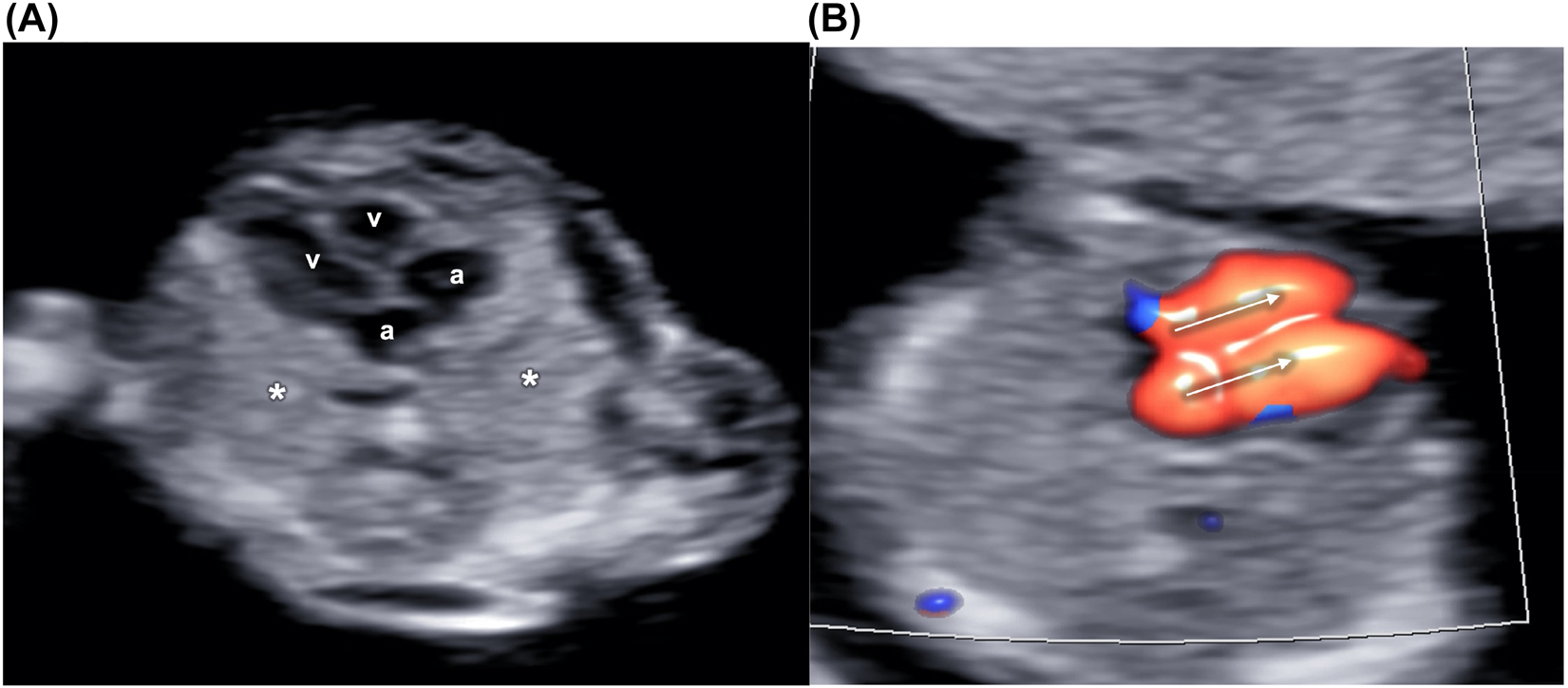 Figure 6: 
Grayscale image of the fetal heart and thorax.
The lung fields are visible on the sides of the heart, showing four balanced chambers, two atria (A) and two ventricles (v) (B) The atrioventricular flows (arrows) are highlighted by color Doppler on a four-chambers view.
