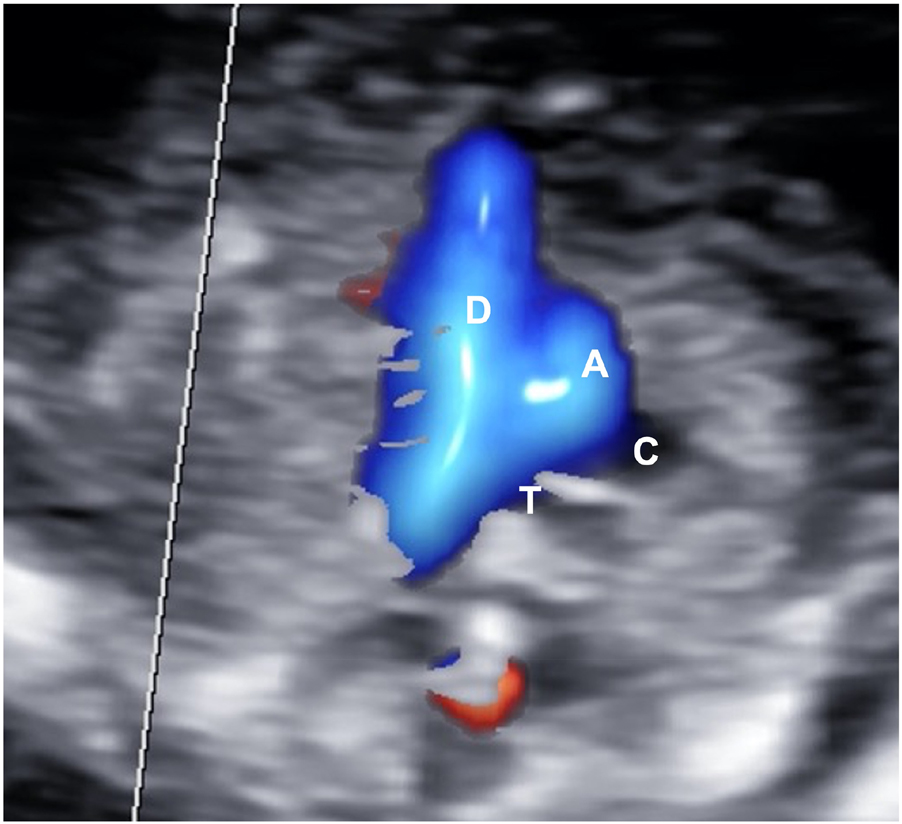 Figure 7: 
Aortic (A) and ductal (D) arches (V-shape) highlighted by color Doppler on a three vessels and trachea view.
The aortic arch is on the left of the trachea (T). Superior vena cava (C) is just on the right of the aorta (A).
