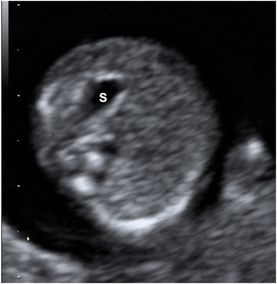 Figure 9: 
Axial view of the fetal abdomen and stomach (S), lying on the upper left part of the abdomen.
