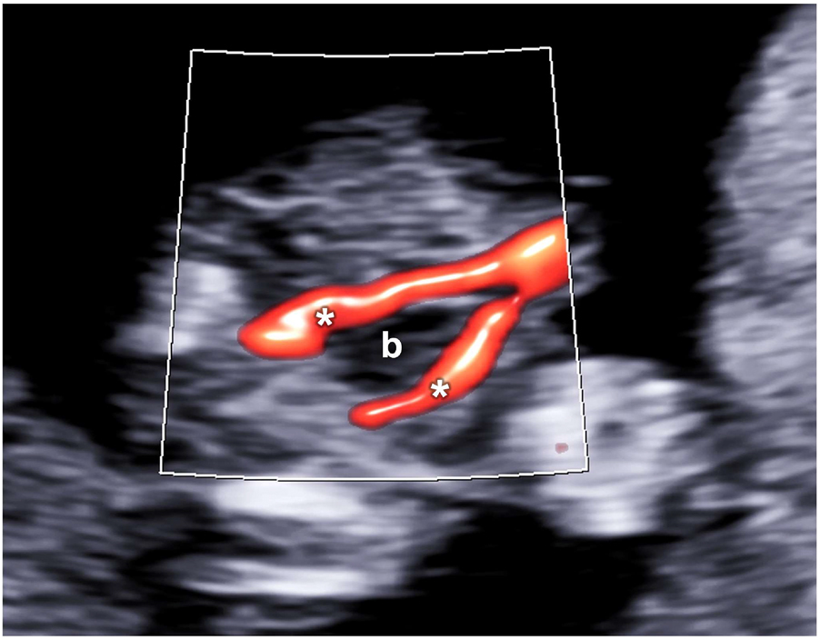 Figure 10: 
On the axial plane, the fetal bladder (b) could be visualized as an anechoic structure surrounded be the perivesical arteries (*).
